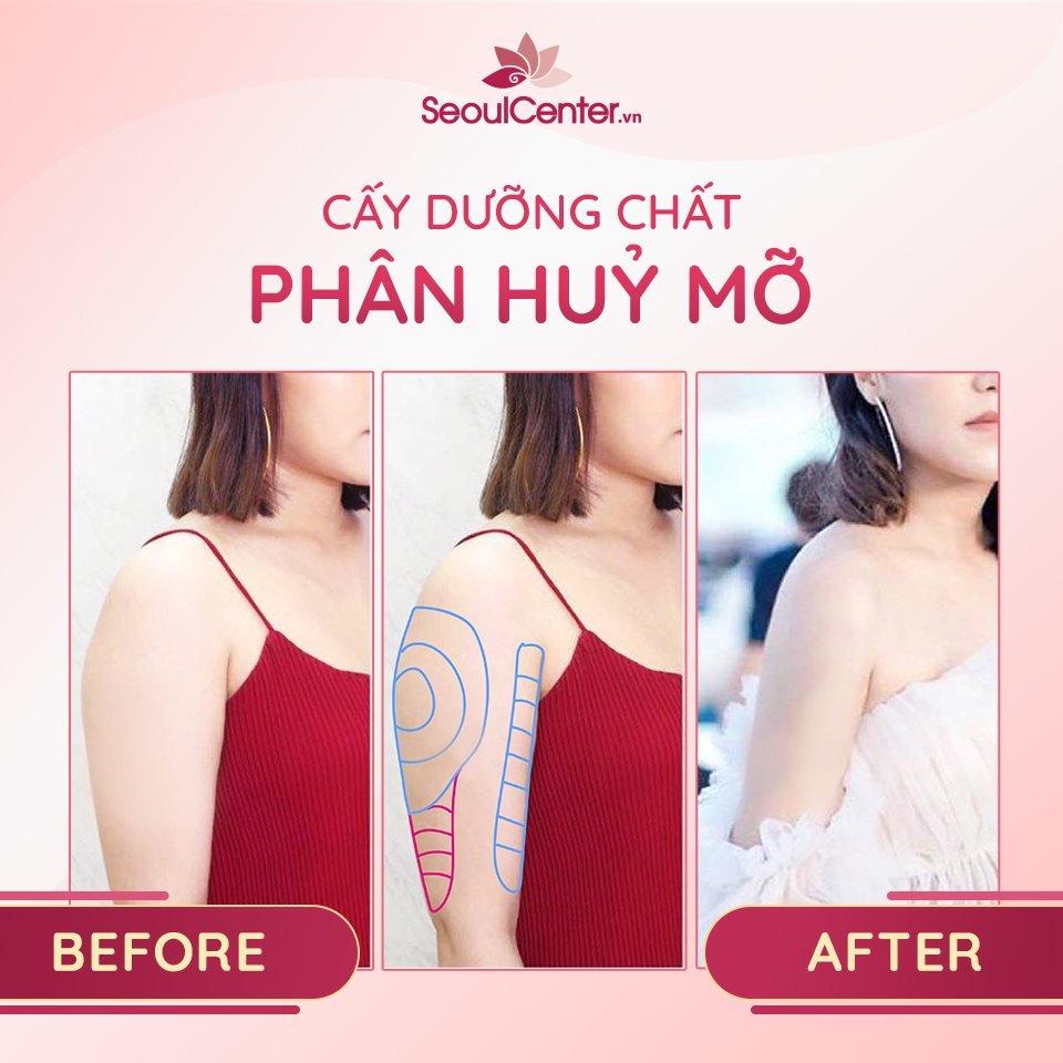 Phân hủy mỡ bắp tay giúp tay thon gọn