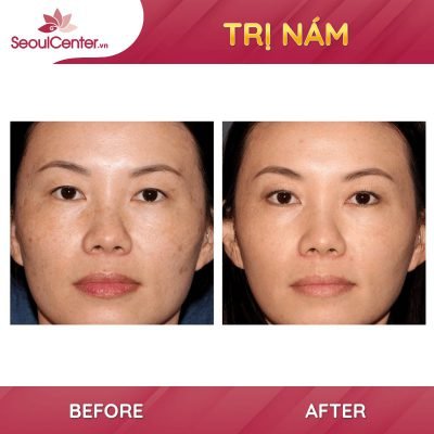 Trị nám siêu hiệu quả tại Seoul Center