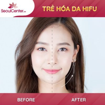 Trẻ hóa da công nghệ hifu da trắng sáng
