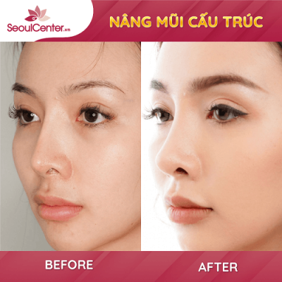 Nâng mũi cấu trúc