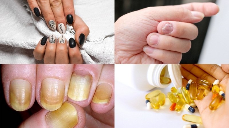 Một số nguyên nhân gây vàng móng tay Một số nguyên nhân gây vàng móng tay