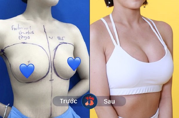 Vòng 1 thay đổi sau khi nâng ngực