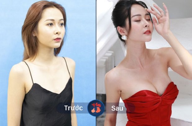 Kết quả trước và sau khi nâng ngực tại Kangnam