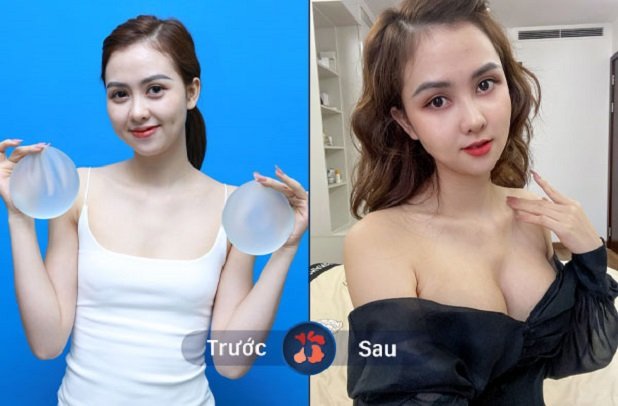 Hình ảnh trước và sau khi nâng ngực Nano Chip tại Kangnam