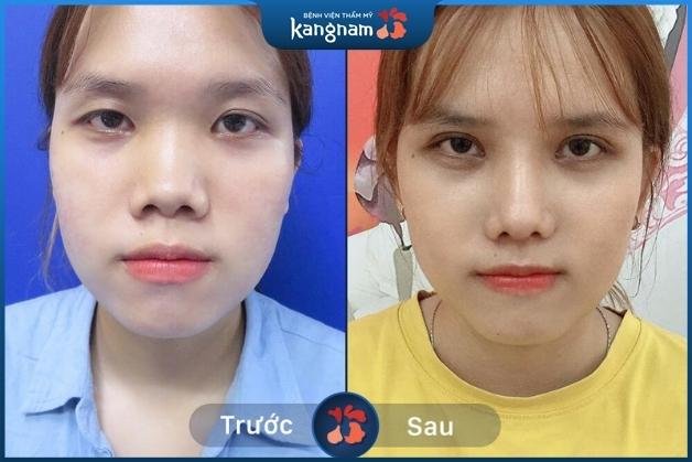 Khách hàng nâng mũi tại Bệnh Viện Kangnam