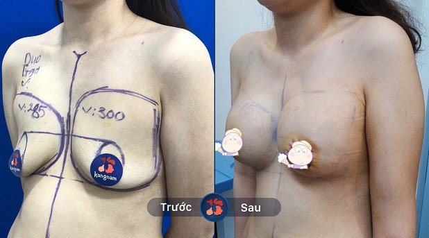 Ngực hơi chảy được hô biến về tỉ lệ hoàn hảo sau phẫu thuật