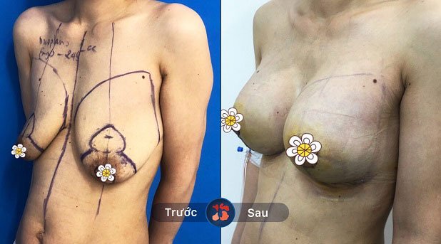 Khắc phục hoàn toàn vú chảy xệ và lệch lạc