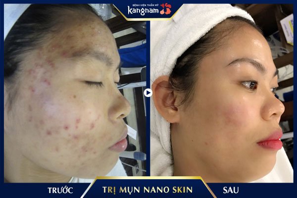 hình ảnh trị mụn nano skin