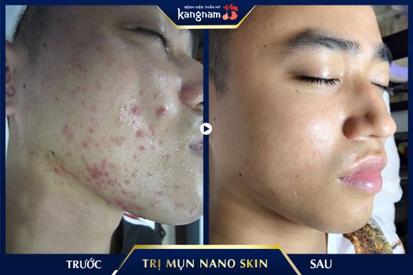 trị mụn nano skin kangnam