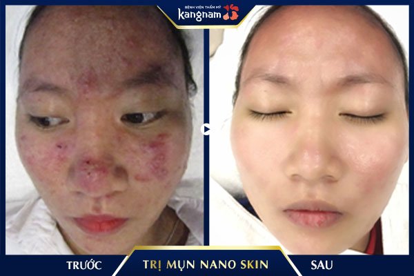 trị mụn nano skin kn