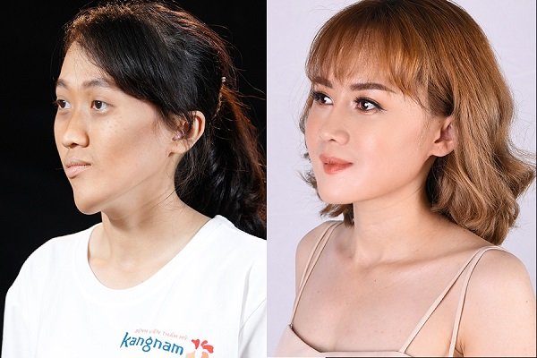benh-vien-tham-my-kangnam-tp-ho-chi-minh-5