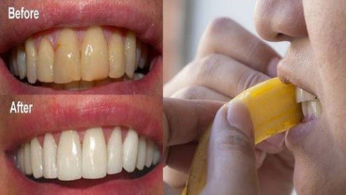 lấy vôi răng bằng vỏ chuối