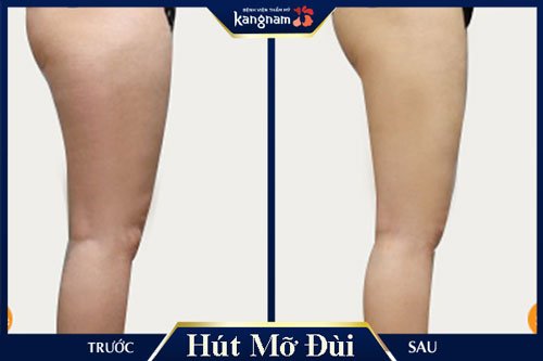 làm sao để đùi thon gọn nhanh nhất
