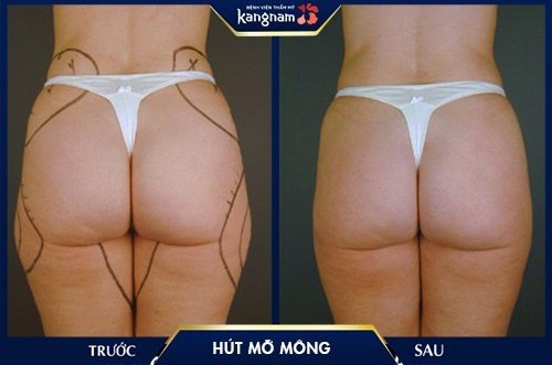 cách giảm vòng 3 quá khổ