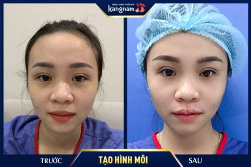 cách làm môi mỏng tại nhà cho nam