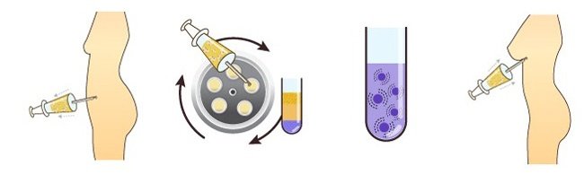 Cấy mỡ tự thân sử dụng lượng mỡ dư thừa ở vùng khác trên cơ thể để bơm vào ngực