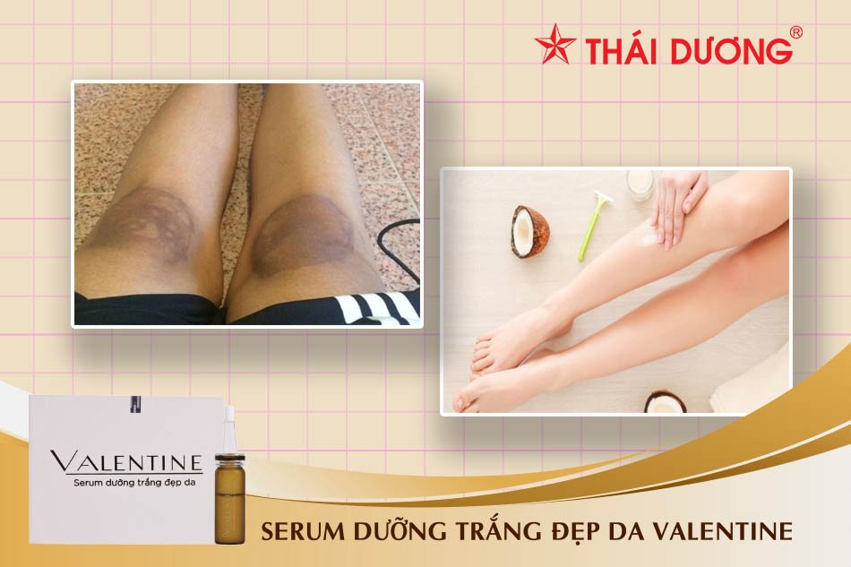 Cách trị thâm đầu gối hiệu quả