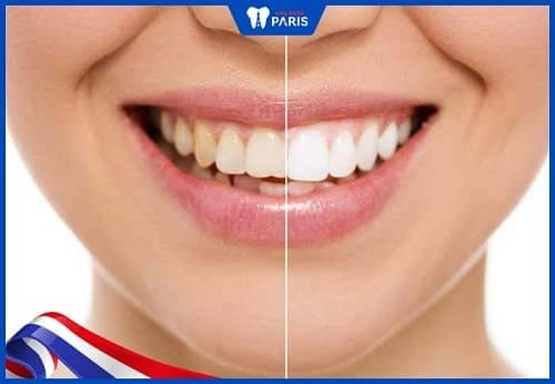 cách làm trắng răng bị vàng