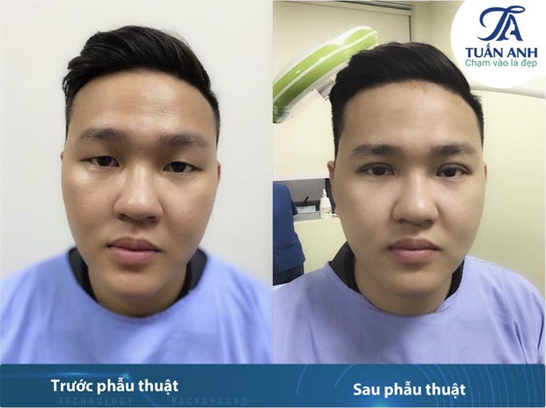 địa chỉ cắt mí mắt đẹp, uy tín nhất ở Hà Nội