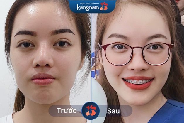 Khách hàng lột xác trở nên xinh đẹp hơn khi cấy mỡ mặt