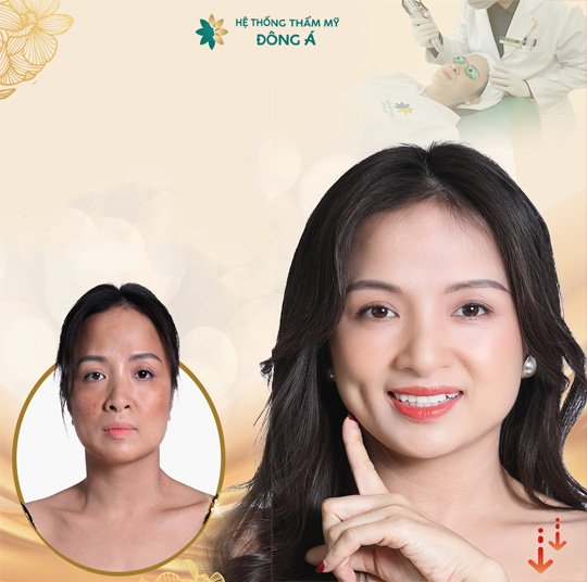 chi phí điều trị nám