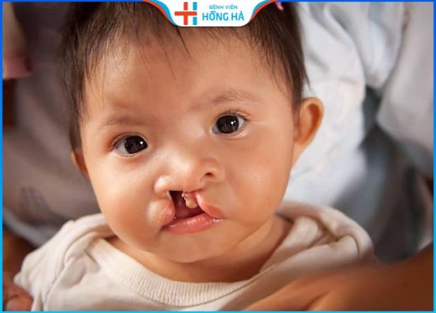 Trào ngược thức ăn ở trẻ hở hàm ếch
