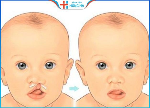 Chi phí Phẫu thuật hở hàm ếch có giá khoảng 6 triệu đồng