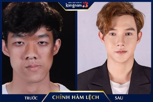 chỉnh mặt bị lệch chỉnh mặt bị lệch