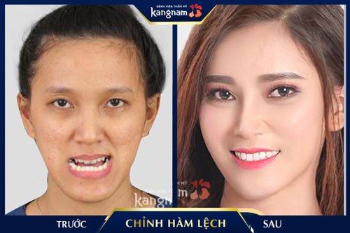 Trước: hàm móm, mặt lệch sang bên phải - Sau: gương mặt thon gọn, thanh tú, đẹp tự nhiên chỉnh mặt lệch