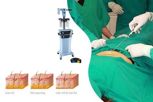 Hút mỡ nội soi