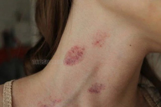 dau-hon-hickey-la-gi