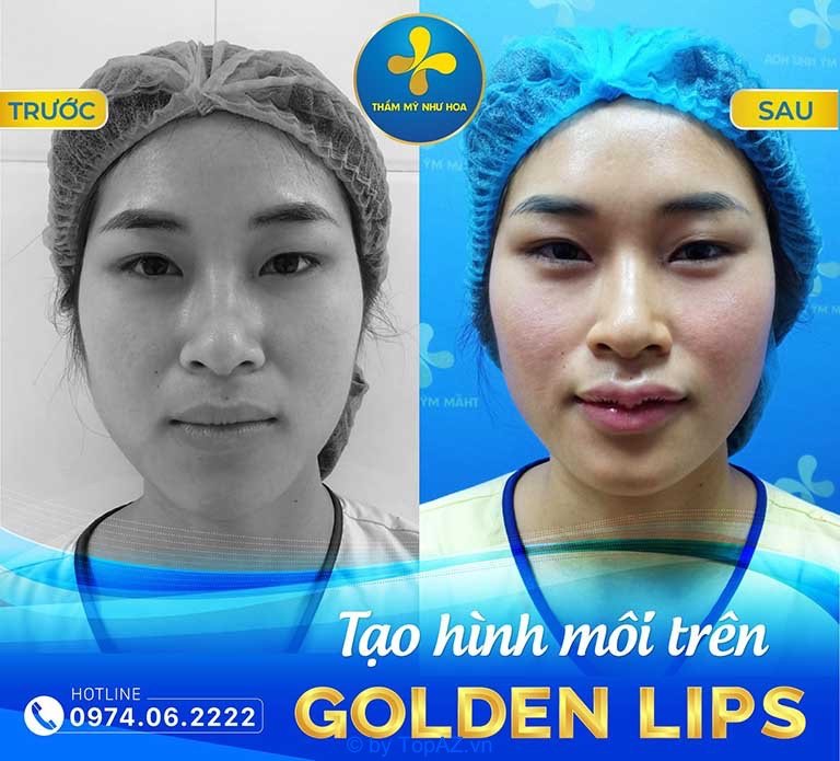Địa chỉ cắt môi trái tim đẹp tại Hà Nội