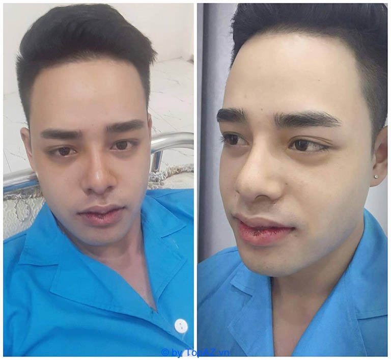 Địa chỉ cắt môi trái tim đẹp tại Hà Nội