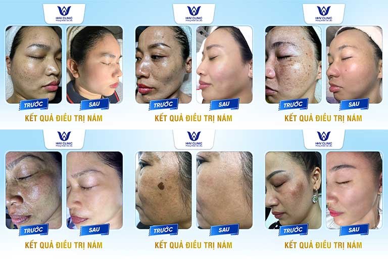 trị nám uy tín tại tphcm