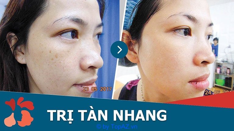 địa chỉ trị nám tàn nhang uy tín tphcm