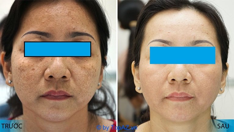 trị tàn nhang ở thẩm mỹ viện nào tốt tphcm