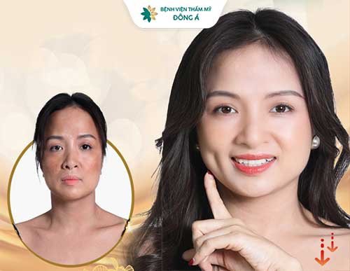 điều trị da thẩm mỹ đông á cần thơ