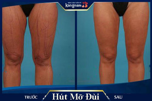 cách làm đùi thon gọn lại