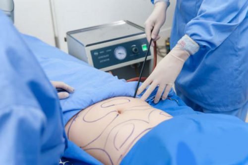 làm sao giảm mỡ mông