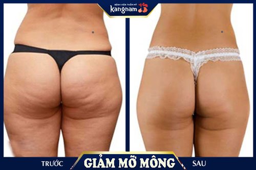 mỡ ở mông