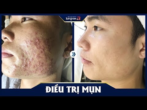 video trị mụn