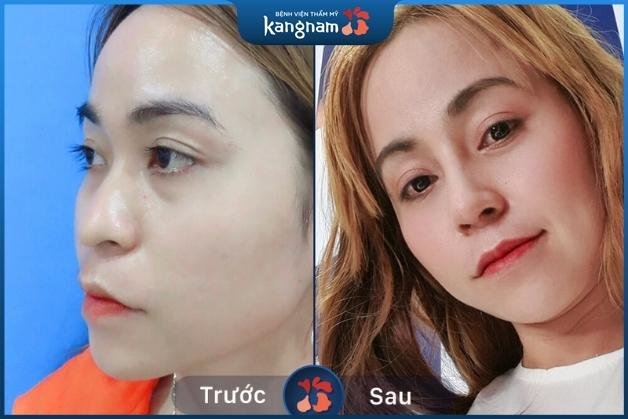 Lột xác “ngoạn mục” sau nâng mũi tại Kangnam