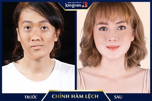 khắc phục mặt không cân đối khắc phục mặt không cân đối