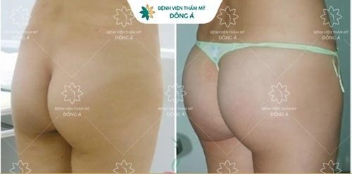cách làm mông nhỏ lại