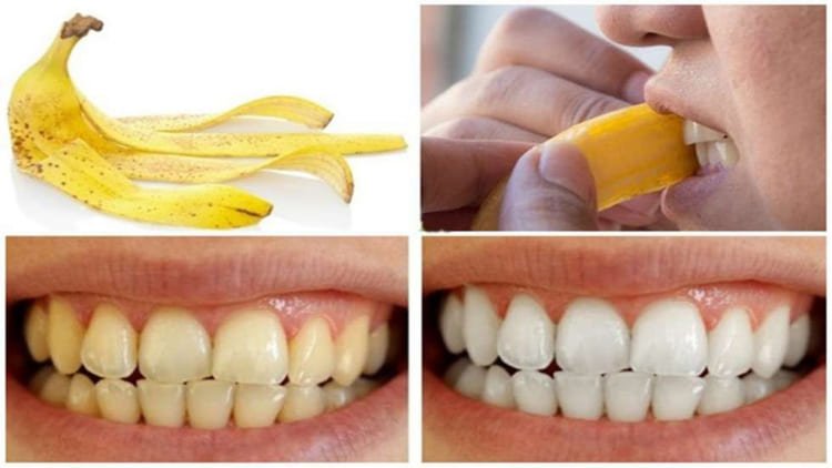 Các bước thực hiện làm trắng răng với vỏ chuối Bước 1 - Bóc vỏ chuối: Đơn giản chỉ cần nhặt lấy một quả chuối và bóc vỏ nó. Phần thịt quả vừa bổ dưỡng lại ngon miệng nên bạn có thể để dành lại để thưởng thức sau. Nên chọn một quả chuối đã chín vì đây là giai đoạn quả có nhiều khoáng chất và có ít đốm đen trên vỏ. Bạn có thể chỉ dùng một thớ vỏ hoặc toàn bộ vỏ của một quả chuối đều được. Bước 2 - Chà vỏ chuối lên răng: Tiếp theo, bạn dùng mặt trong của vỏ chuối để chà lên răng. Tiếp tục chà xát cho đến khi nhận thấy mặt ngoài răng của bạn phủ đầy lớp thịt nhão bên trong vỏ chuối. Cố gắng chà kỹ để không bỏ sót những kẽ răng. Sau đó chờ thêm khoảng từ 2 đến 5 phút để vỏ chuối phát huy tác dụng. Trong khoảng thời gian này cố gắng không nói hay Bước 3 - Chải răng: Sau khi đã chờ đủ thời gian, bạn bắt đầu dùng bàn chải để chải nhẹ nhàng theo chuyển động tròn trên mặt ngoài của răng trong 2 phút. Không cần phải quá mạnh tay vì có thể sẽ làm tổn thương đến răng và nướu. Sau đó, súc miệng lại với nước sạch và dùng kem đánh răng nếu muốn. Để đạt hiệu quả, bạn cần phải lặp lại phương pháp này trong ít nhất 2 tuần.