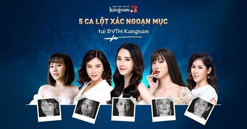 BVTM Kangnam tổ chức chương trình Hành trình lột xác giải cứu những khuyết điểm khuôn mặt lệch, vẹo mặt bị lệch và cách khắc phục