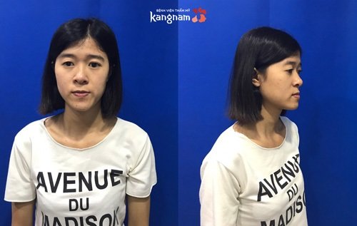 Mặt lệch là gì? mặt bị lệch