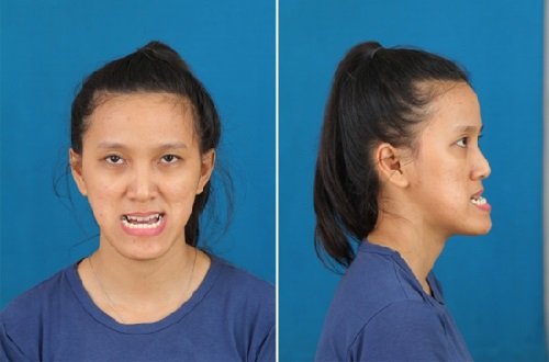 Hình ảnh mặt bị lệch do nguyên nhân xương hàm, xương cằm phát triển lệch lạc mặt không cân đối