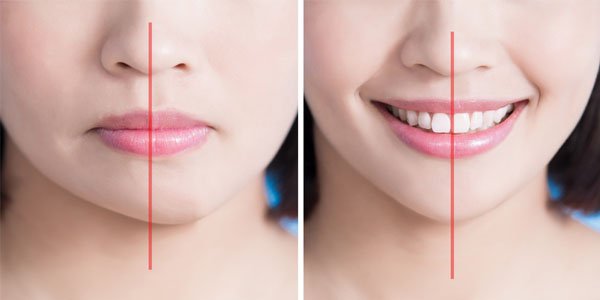 mặt lệch là gì