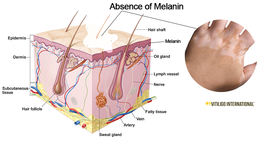 Melanin là yếu tố quyết định màu da con người